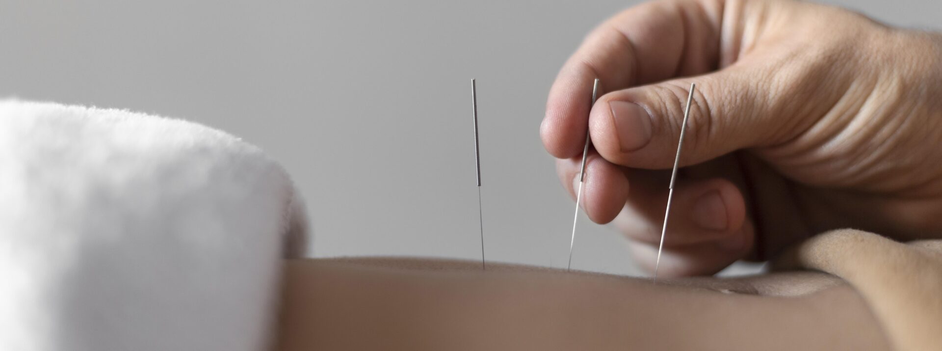 Acupuncture